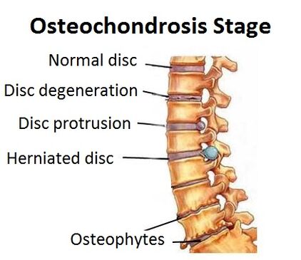 Osteochondrosis phase