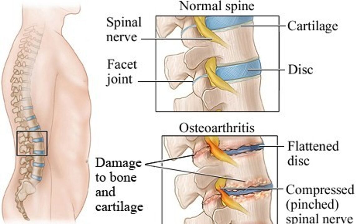 The difference between a healthy disc and a disc with osteochondosis
