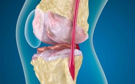The reasons for the development of arthrosis of the knee joint